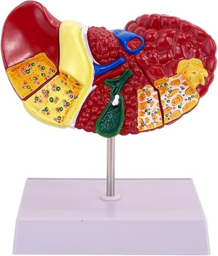Modèle d'anatomie de la cirrhose du foie à texture claire