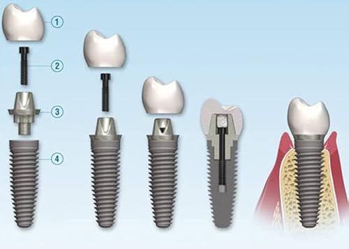 Dental implant procedure: The procedure for having beautiful teeth