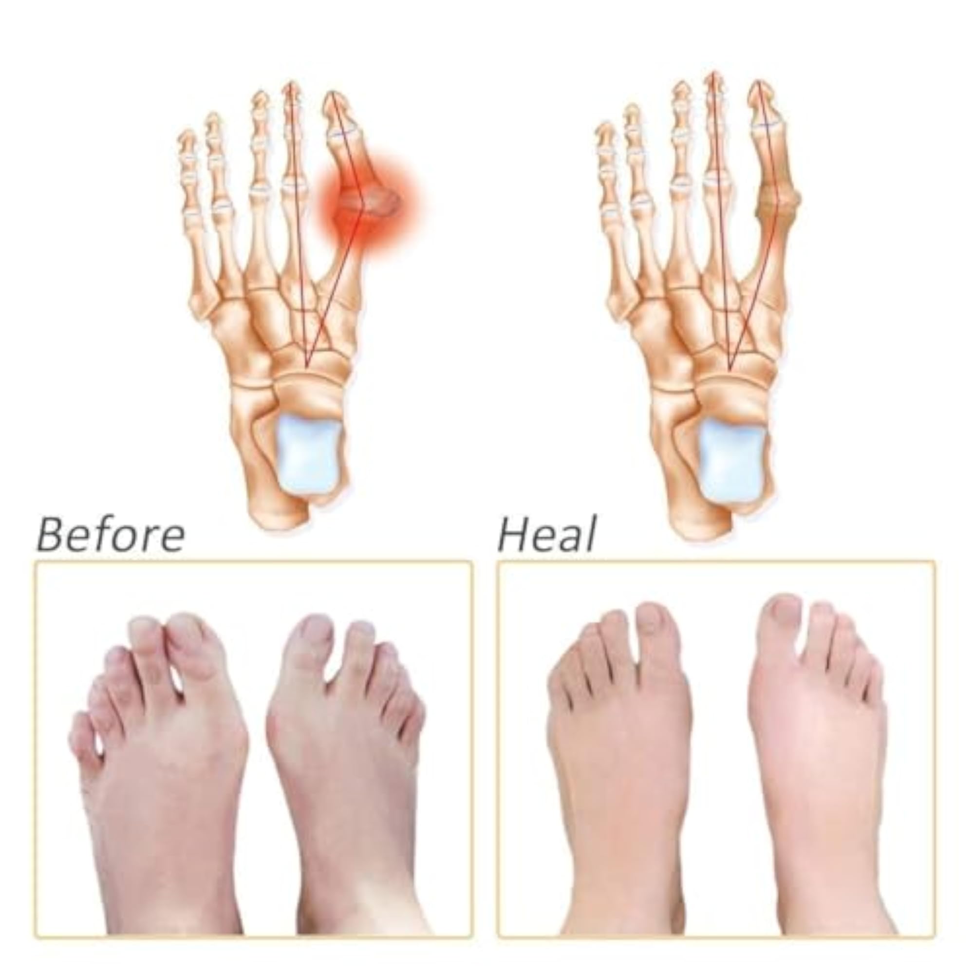 Silicone Gel Half Toe Sleeve Socks for Pain Relief