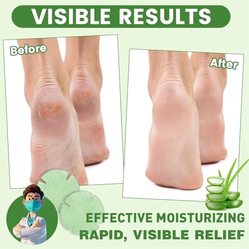 TEAWOO 30PCS Patented Aloe Vera Cracked Heel Treatment Patches, New Upgraded Cracked Heel Repair Bandage