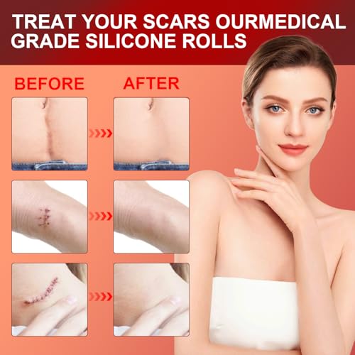 Tearich QBT-01 Silicone Scar Sheets thumb #3