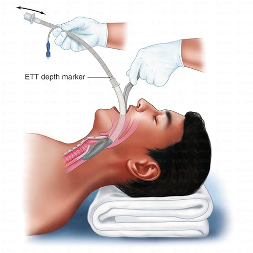 Image of OTICA Sterile Laryngeal Mask Airway - Disposable LMA | PVC material | Size-3 No.