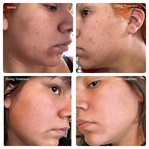 Admire My Skin Dark Spot Corrector Remover for Face - Brightening Serum Fade Cream - Melasma Treatment Cream with Synovea, Kojic Acid, Vitamin C, Salicylic Acid, Azelaic Acid, Lactic Acid Serum Peel