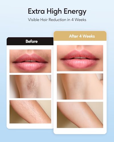 INNZA IPL Hair Removal Corded Version