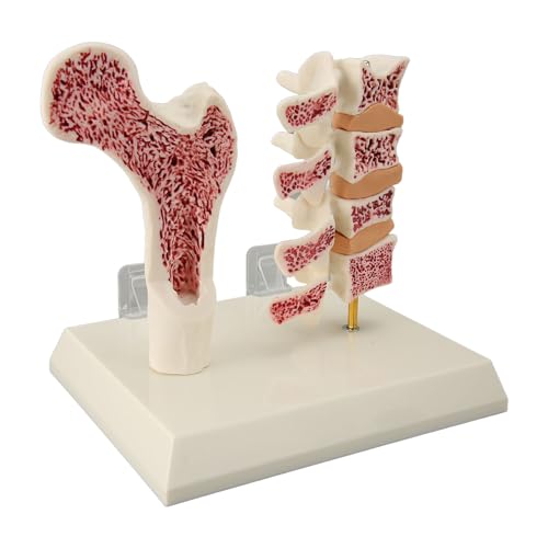 Image of ZJchao Osteoporosis Spine Model, ABS Anatomical Osteoporosis Model, Pathological Changes Visualization Versatile Learning Tool for Anatomy Education Constructed