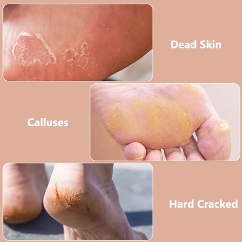 OWIIZI Râpe à pieds pour pédicure pour enlever les callosités, râpe exfoliante pour pieds en acier inoxydable, râpe à pieds, grattoir pour peaux mortes et craquelées, pour pieds humides et secs – vue 3