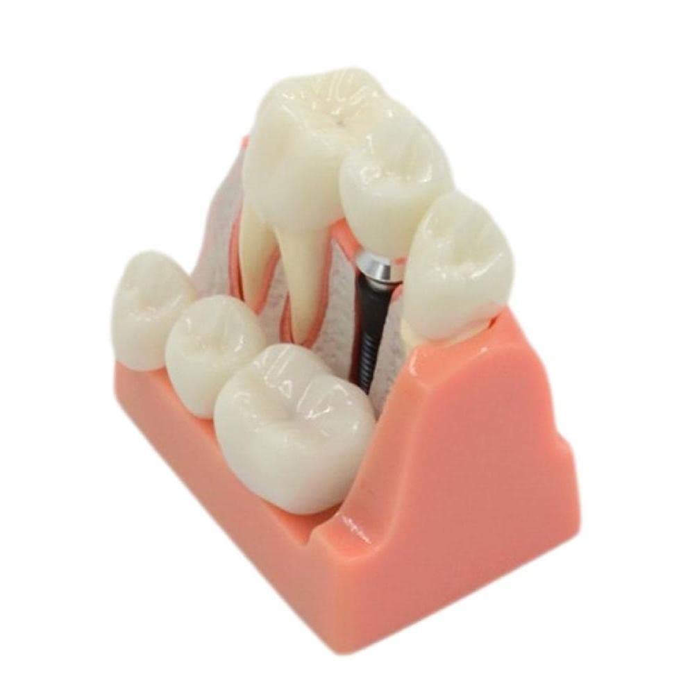 Modèle de dents flexibles WUURAA à bridge amovible explicatif