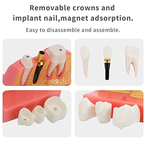 Annhua 4 Times Dental Implant Teeth Model Analysis Crown Bridge Demonstration Model, Dental Teeth Crown Roots Removable For Education, Patients Communication, Learning And Lab #TOP5