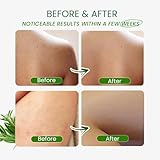 Tea Tree Body Wash Antifungal: Folliculitis Treatment for Dermatitis-Prone Skin, Face & Body Acne, Jock Itch, Athlete’s Foot, Ringworm, Tinea Versicolor, Body Odor, Eczema and Hidradenitis Suppurativa - Image 5
