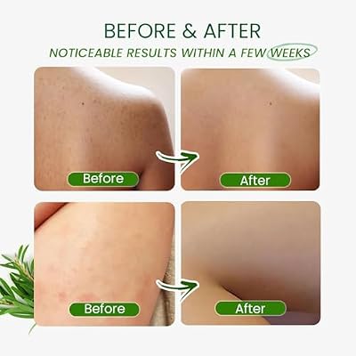 PHARMBANNER Tea Tree Antifungal Body Wash Soothes Folliculitis, Acne, Jock Itch, Athletes Foot, Ringworm, Tinea Versicolor, Body Odor, Eczema & Dermatitis-Prone Skin