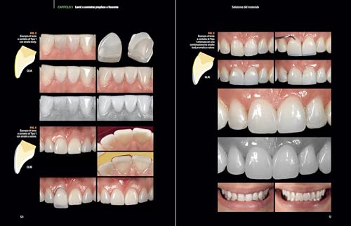 Faccette In Composito. La Tecnica Diretta-Indiretta - 4