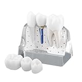 Hoite Zahnimplantatmodell, transparent, mit Harzkronen, Metallimplantaten, Abutments, trennbaren Teilen, 4 x Magnete, sichere Brücke