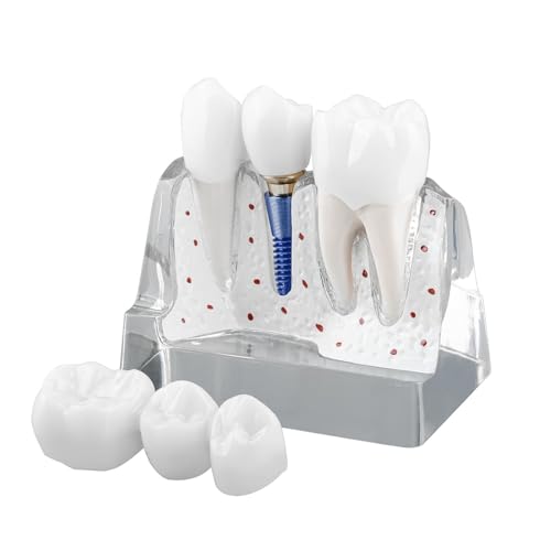 Hoite Modelo de implante dental transparente con coronas de resina, implantes metálicos, pilares, piezas separables, 4 imanes, puente de seguridad.