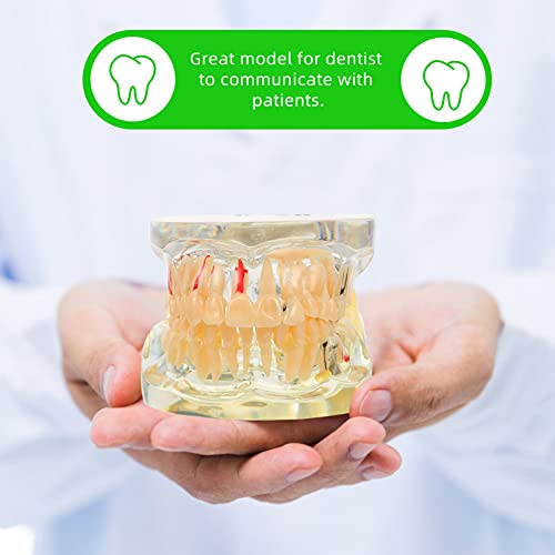 DOITOOL Tandheelkundig implantaat Tanden Model Transparante Volwassen Pathologieën Implantaat Demonstratie Tanden… - Image 4
