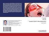  Lasers Use in Periodontics: Use of Lasers