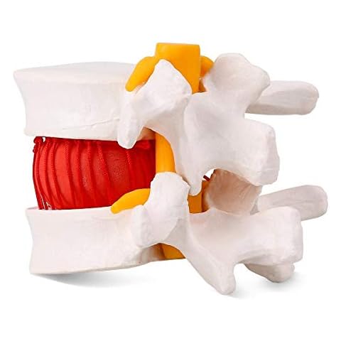 Rasamer Human 1.5 Times Life Size White Anatomical Lumbar Disc Herniation Model - Lumbar Spine Model for Teaching & Learning Demonstrating Disc Cover