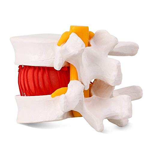 Image of Premium ✮ Lumbar Disc Herniation Model ✮ Lumbar Spine Model for Teaching & Learning ✮ Excellent Way for Demonstrating Herniated Lumbar Disc