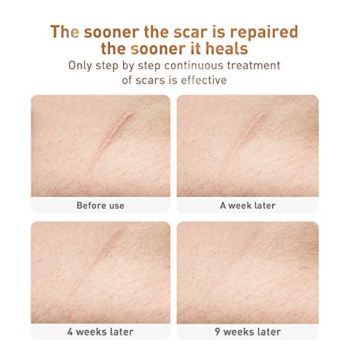 image for LANBENA Acne Scar Removal Cream Stretch Marks Face Skin Cream Shrink P