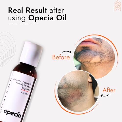 Image of Alopecia Hair Patch Regrowth Oil (50ml) Alopecia Areata Treatment Oil | 100% Pure Extract with No Side Effects