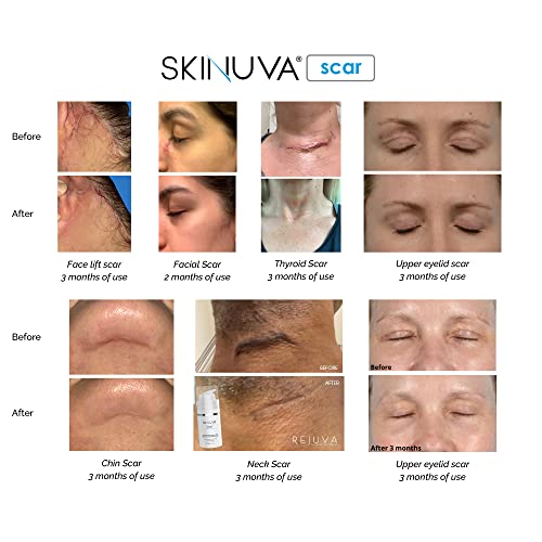 Skinuva® Next Generation Scar Cream - Advanced Scar Cream Formulated With Growth Factors (0.5 Oz) #TOP3