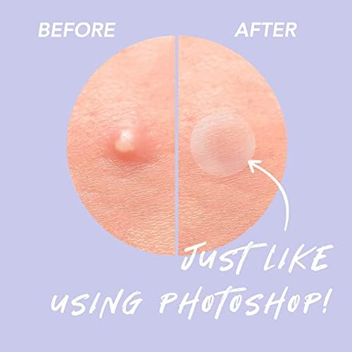 Acne Patches Aliobio Hydrocolloid Patches Pimple Patches Spot Patches Invisible Acne Stickers (6 sheet/216 Patches)