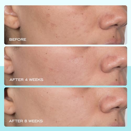 First-Aid-Beauty-Dark-Spot-Serum-with-Niacinamide--Helps-Brighten-Look-of-Dark-Spots-Sunspots-Hyperpigmentation-on-the-Face--1-oz