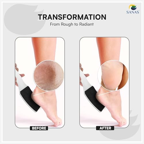 Image of Sanas foot scrubber for dead skin (1 Pcs) Pedicure Foot File, Foot Cleaner for Cracked Heels, Feet Scrubber, Dead Skin Remover Foots Tool, foot scrubber Pedicure Tools for Smooth Soft Feet (1Pcs)