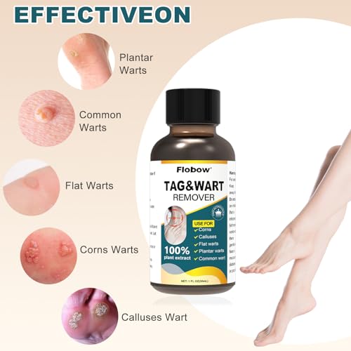 Image of Skin Tag Remover,Wart Remover Freeze Off Liquid with 17% Salicylic Acid - Fast-Acting Freeze Off Treatment for Common & Plantar Warts,Flat Wart, Corns - for Feet, Hands & Body 1Ounce