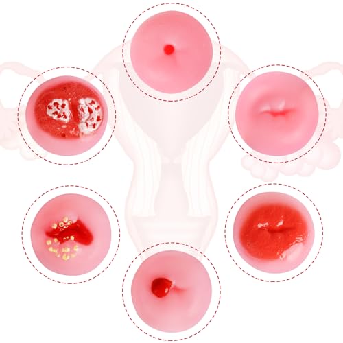 Image of SimCoach Cervix Replicas Model, 6 Cervical Pathology Models for OB /GYN Training & Patient Education, Gynecological Teaching Tool
