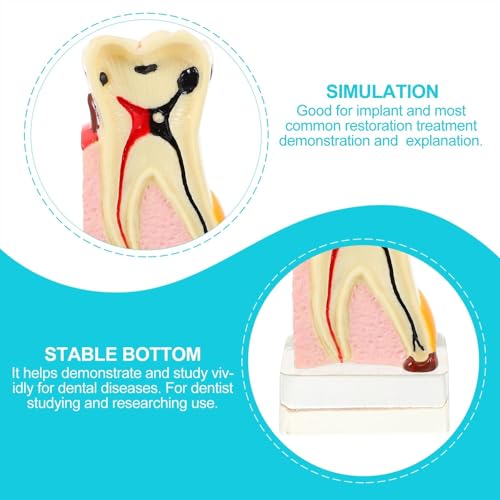 Modèle de démonstration dentaire et de carie enseignement buccal - 3