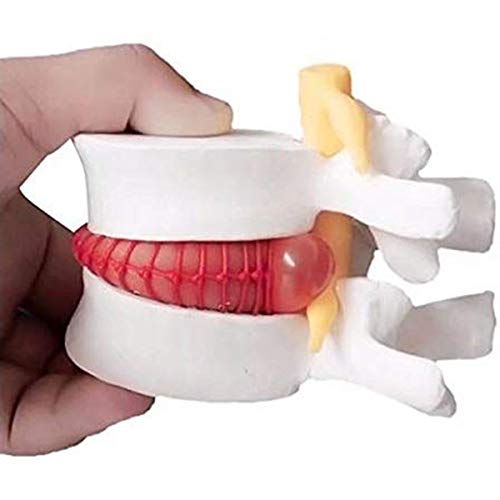Starmood - Ernia anatomica del disco lombare della...