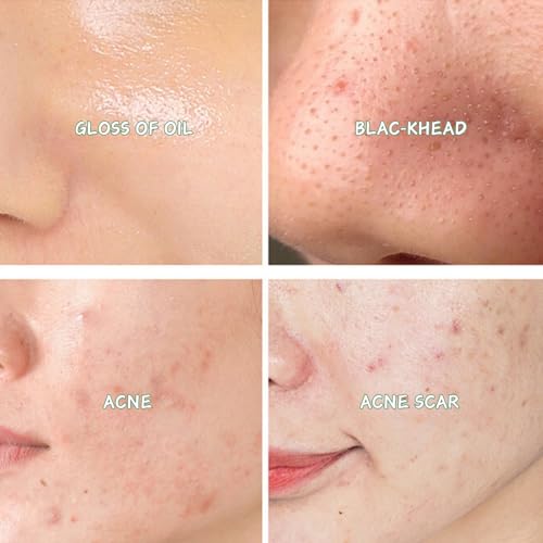 Tea Tree Acne Treatment Skin Care Kit - Salicylic Acid Skin Care Set - Acne Treatment for Face - Skin Care for Teens 10-12 - Salicylic Acid Serum,Clean Foam,Toner,Face Cream - Christmas Gifts Acne Kit