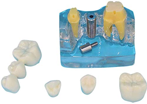 Modèle De La Dent Humaine, Modèle Dentaire Transparent Personnes Modèle Oral, Implant Dentaire Utilisé pour La Recherche dans Les Domaines De La Communication Ou L'Affichage Patients