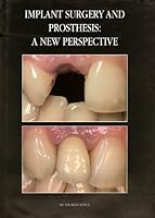 Implant Surgery and Prosthesis: A New Perspective 8487673082 Book Cover