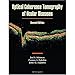 Optical Coherence Tomography of Ocular Diseases