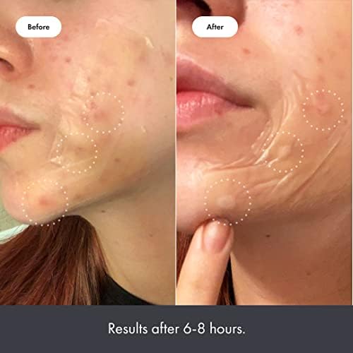 Mighty Patch Surface - Hydrocolloid Large Acne Pimple Patch Spot Treatment (10 count) for Body and Larger Breakouts on Cheek, Forehead, Chin, Vegan, Cruelty-Free