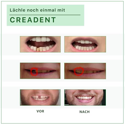 CREADENT Set für den Ersatz eines fehlenden Zahns durch einen provisorischen, kosmetischen Zahn