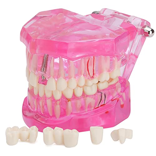 LVCHEN Transparent Dental Implant Teeth Model - Transparent Disease Teeth Model Pathological Tooth Model with Removable Teeth for Dental Study and Education