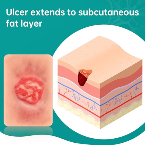 Image of Pressure Ulcer Wound Model Stage 3 Pocket Size