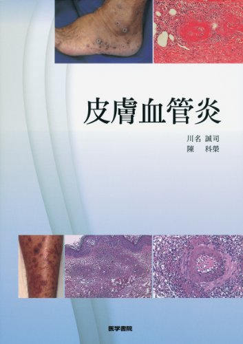 無料電子書籍 pdf 皮膚血管炎 バイ