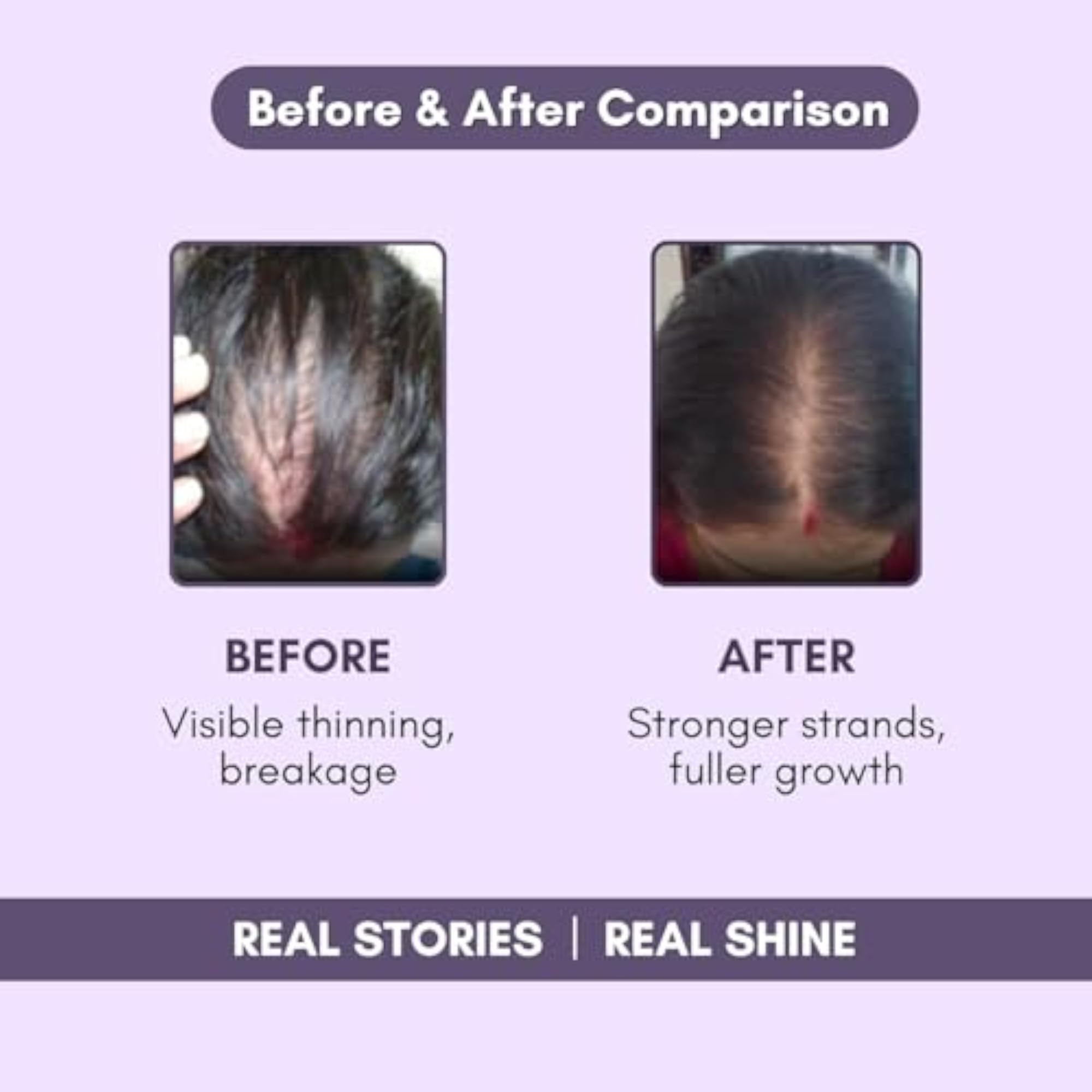 Biotin Gummies for Hair Growth & Hair Fall Control