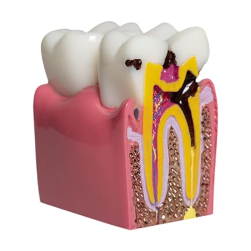 JISADER 6 Veces La Anatomía de La Caries de Resina del Modelo Caries para El Aula de Demostración