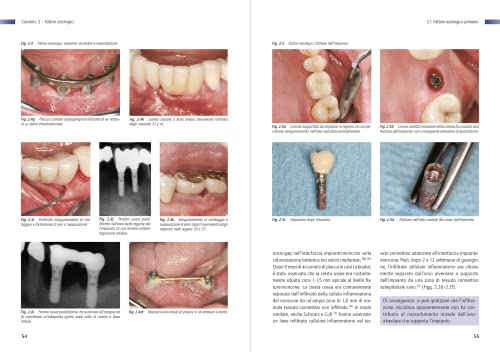 Infezione Perimplantare: Eziologia, Diagnosi E Trattamento - 7