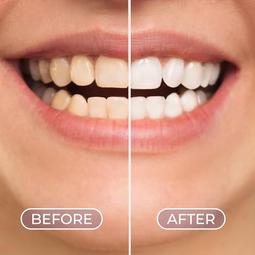 Image of Whitening Foam 50ml - Brightening White Teeth Colour Corrector for Whiter, Brighter Smile - Advanced Tooth Whitening Foam