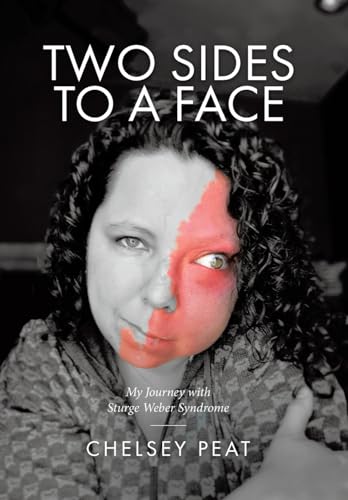 Two Sides to a Face: My Journey with Sturge Weber Syndrome