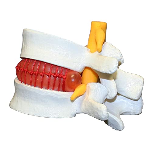 Image of B10235 Plastic Prolapsed Intervertebral Disc Model