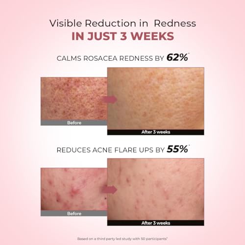 Image of Conscious Chemist 10% Azelaic Acid Cream | 50g | Face Cream for Men & Women, Moisturizer for Acne Prone Skin, Redness Relief, Soothe Irritation & Inflammation, All Skin Types - Azicalm
