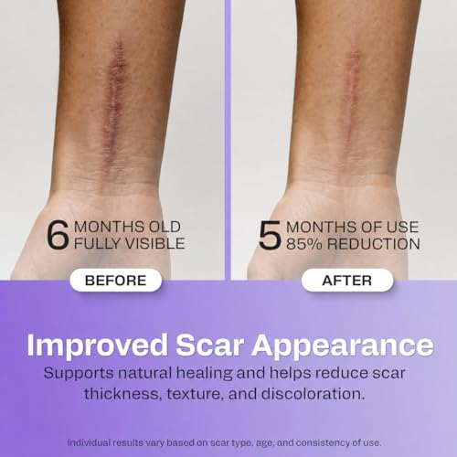 Image of Silicone Scar Sheets for Breast - Reusable Medical Grade Scar Tape for Surgical Scars, C-Section, Face - Waterproof Silicone Patches for Scar Healing and Removal - Precut Strips 60 inch Roll