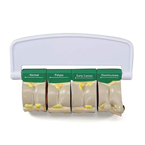 GPI Anatomicals - 4-Piece Colon Model, Replica of a Colon with Pathologies for Human Anatomy and Physiology Education, Anatomy Model for Doctor's Offices and Classrooms, Medical Learning Resources