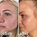 Mandelic Acid Serum Toner Exfoliant | Great For Acne Breakouts, Reduce Redness, Balancing Treatment | Plus Niacinamide, Licorice Root & Hyaluronic Acid, Hydration (Lissy Skincare)